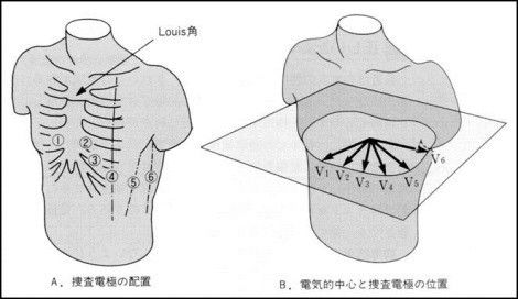 胸部誘導の見方と波形から読み取る心臓疾患