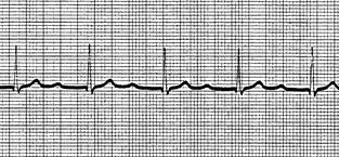 刺激伝導障害の心電図の異常所見の特徴
